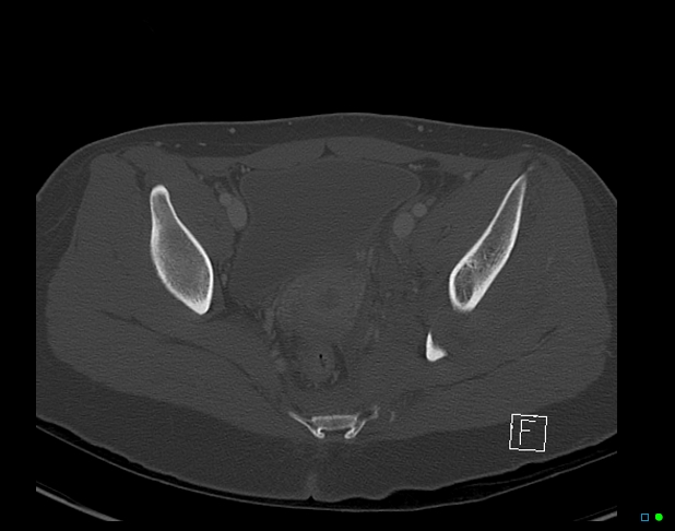 Bilateral acetabular fractures (Radiopaedia 79272-92308 Axial bone window 36).jpg