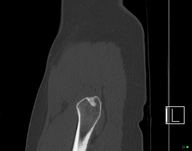 Bilateral acetabular fractures (Radiopaedia 79272-92308 Sagittal bone window 6).jpg