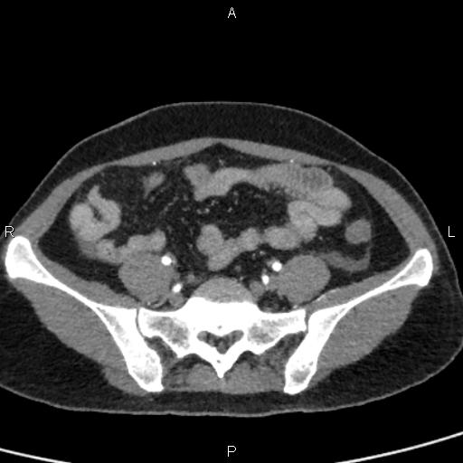 Bilateral adrenal gland hyperenhancement in pancreatitis (Radiopaedia 86642-102753 B 98).jpg