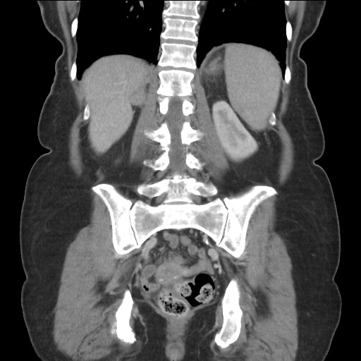 Bilateral adrenal granulocytic sarcomas (chloromas) (Radiopaedia 78375-91007 B 67).jpg
