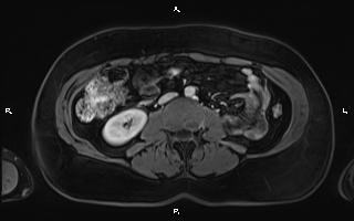 Bilateral adrenal myelolipoma (Radiopaedia 63058-71537 G 62).jpg