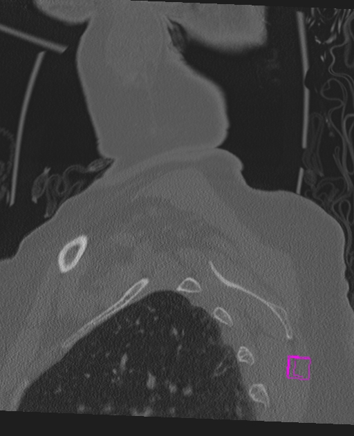 Bilateral atlanto-occipital assimilation (Radiopaedia 28350-28603 Sagittal bone window 79).jpg