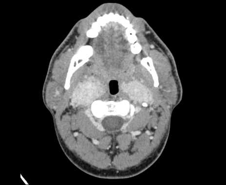 File:Bilateral carotid body tumors (Radiopaedia 61841-69870 Axial Post contrast 29).jpg