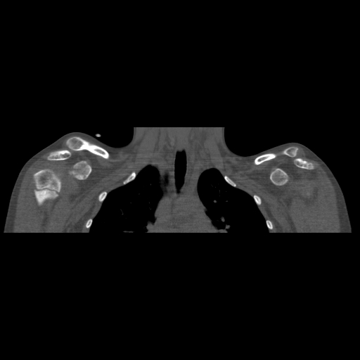 Bilateral chronic posterior shoulder dislocation (Radiopaedia 39213-41452 Coronal bone window 21).jpg
