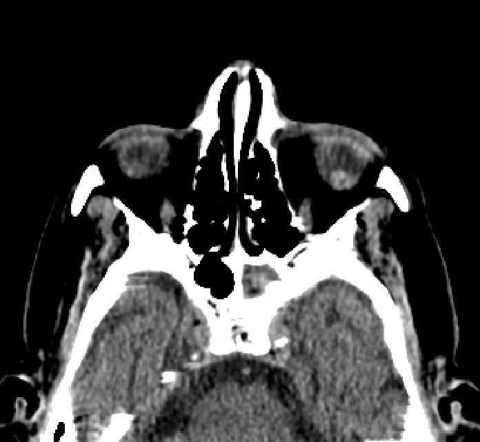 Bilateral ectopia lentis (Radiopaedia 89889-107013 Axial non-contrast 60).jpg