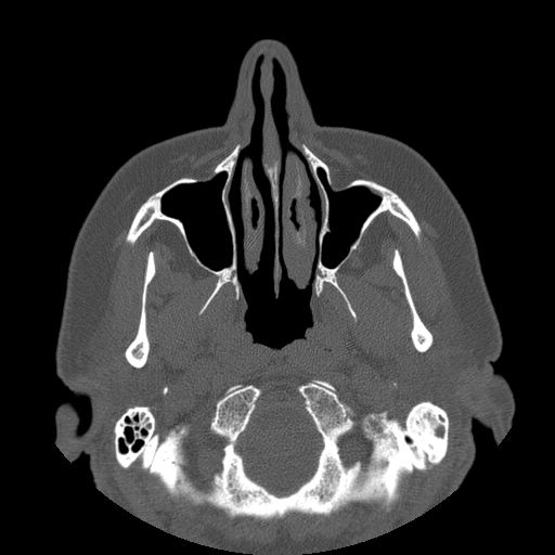 File:Bilateral ectopic infraorbital nerves (Radiopaedia 49006-54084 Axial 11).jpg