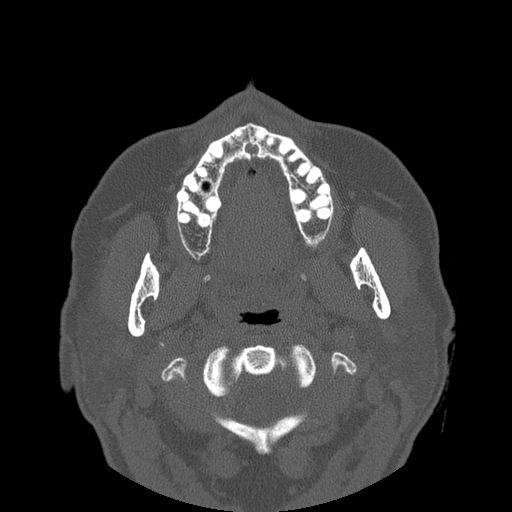 File:Bilateral ectopic infraorbital nerves (Radiopaedia 49006-54084 Axial 16).jpg