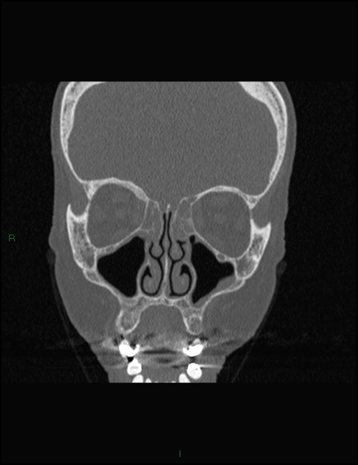 Bilateral frontal mucoceles (Radiopaedia 82352-96454 Coronal 132).jpg