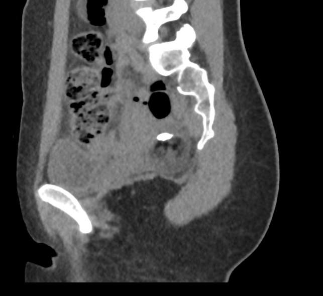 Bilateral mature cystic ovarian teratoma (Radiopaedia 88821-105592 D 20).jpg