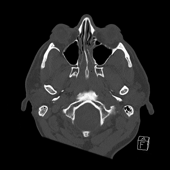 Bilateral occipital condyle fracture (type 2) (Radiopaedia 87675-104089 Axial bone window 12).jpg