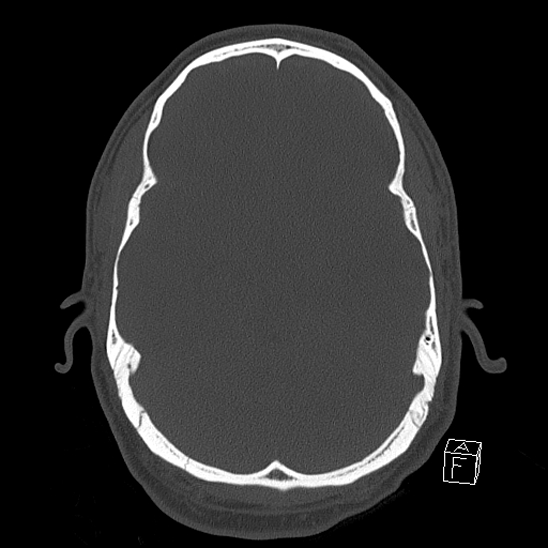 Bilateral occipital condyle fracture (type 2) (Radiopaedia 87675-104089 Axial bone window 51).jpg