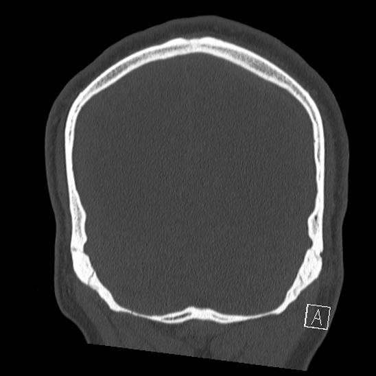 Bilateral occipital condyle fracture (type 2) (Radiopaedia 87675-104089 Coronal bone window 117).jpg