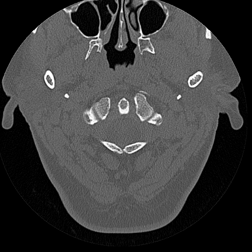 File:Bilateral ossifications of the external auditory canal (Radiopaedia 15233-15076 Axial bone window 30).jpg