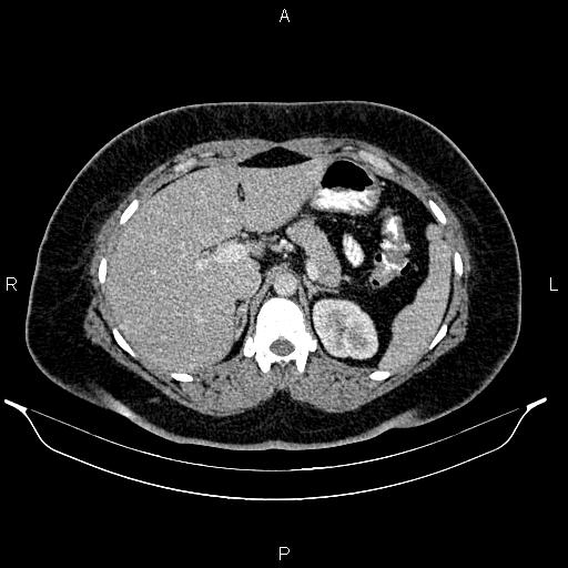 Bilateral ovarian dermoid cysts (Radiopaedia 85785-101603 A 32).jpg