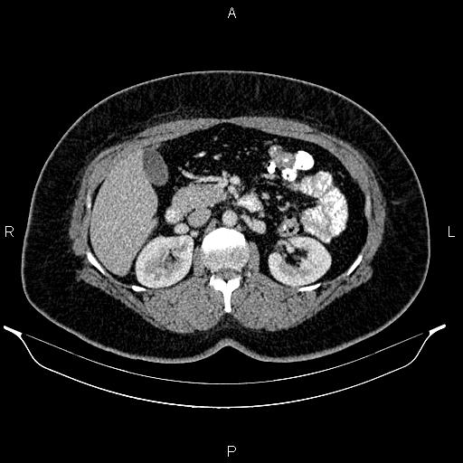 Bilateral ovarian dermoid cysts (Radiopaedia 85785-101603 A 44).jpg
