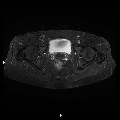 File:Bilateral ovarian fibroma (Radiopaedia 44568-48293 Axial STIR 22).jpg