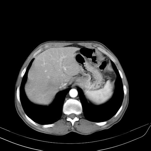 Bilateral parotid gland lymphoma (Radiopaedia 21038-20969 A 50).jpg
