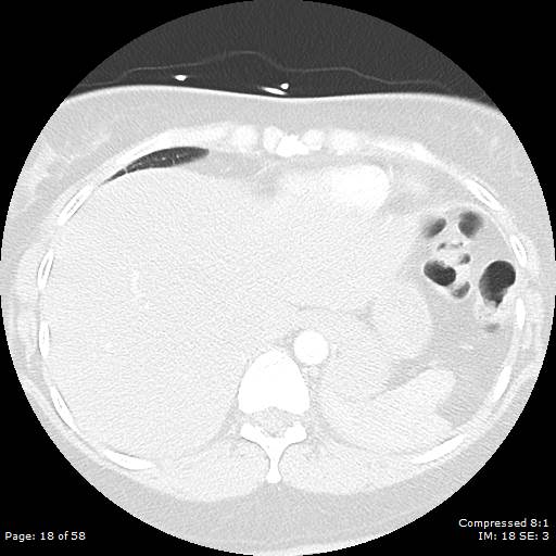 Bilateral pulmonary emboli with Hampton hump sign (Radiopaedia 54070-60246 Axial lung window 18).jpg