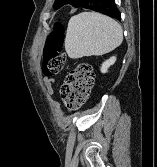 Bilateral rectus sheath hematomas (Radiopaedia 50778-56252 B 18).jpg