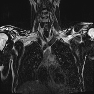 Bilateral spinoglenoid notch ganglion cysts (Radiopaedia 29577-30082 Coronal T2 43).jpg