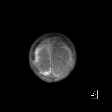 Bilateral subdural hemorrhage and parietal skull fracture (Radiopaedia 26058-26190 Coronal T1 55).png