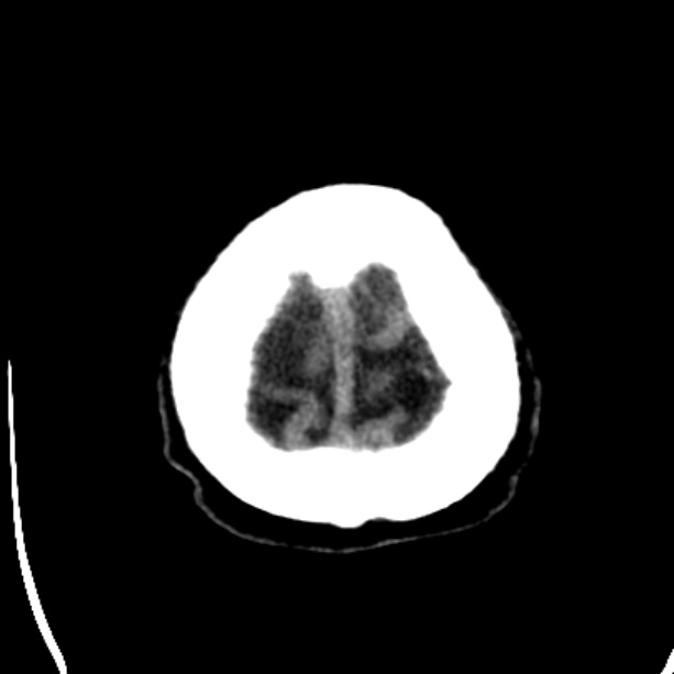 Bilateral subdural hygromata (Radiopaedia 29245-29656 Axial non-contrast 46).jpg