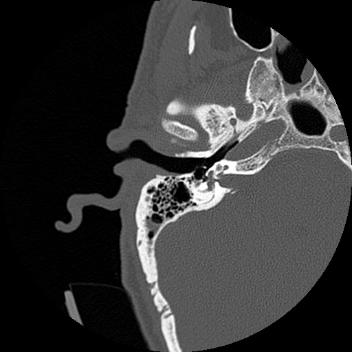 File:Bilateral temporal bone fractures (Radiopaedia 29482-29970 Axial non-contrast 16).jpg