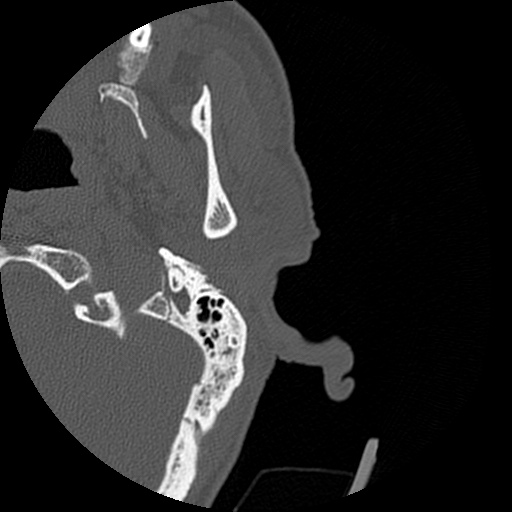 Bilateral temporal bone fractures (Radiopaedia 29482-29970 D 11).jpg