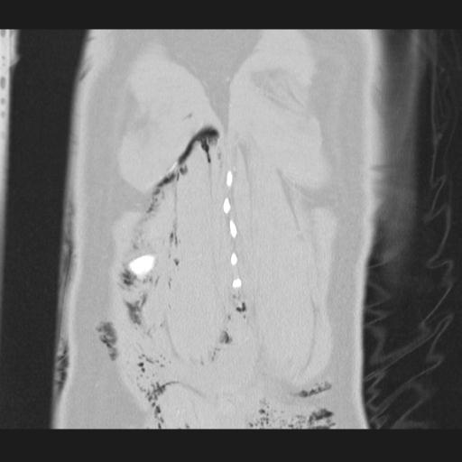 File:Bilateral traumatic renovascular injury (Radiopaedia 32051-32995 Coronal lung window 76).jpg