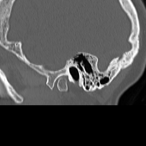 Bilateral tympanoplasty (Radiopaedia 16947-16664 Sagittal bone window 5).jpg