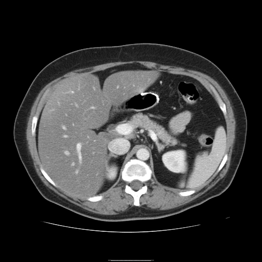 File:Billroth I gastric resection (Radiopaedia 17685-17425 None 3).jpg