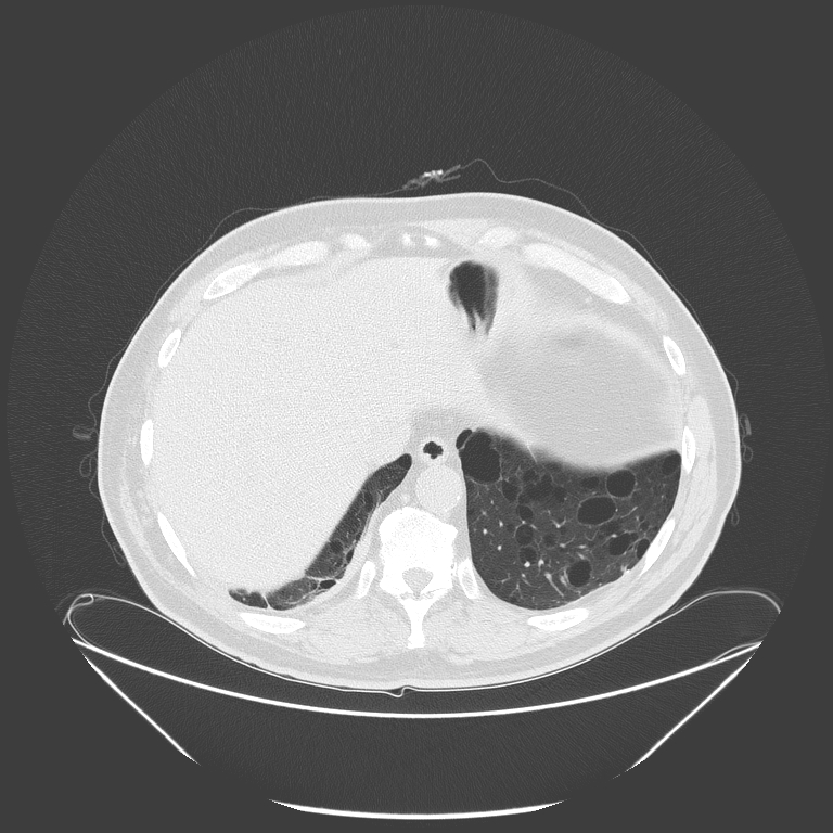 Birt-Hogg-Dubé syndrome (Radiopaedia 52578-58491 Axial lung window 53).jpg