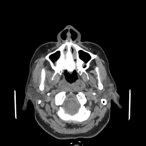 Bisphosphonate-related osteonecrosis of the jaw (Radiopaedia 71324-81642 non-contrast 124).jpg