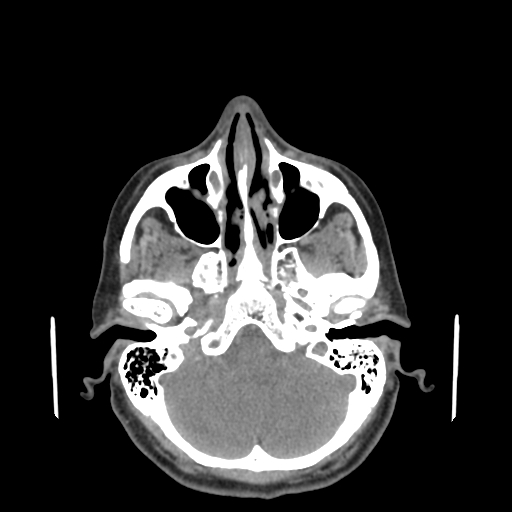 File:Bisphosphonate-related osteonecrosis of the jaw (Radiopaedia 71324-81642 non-contrast 153).jpg