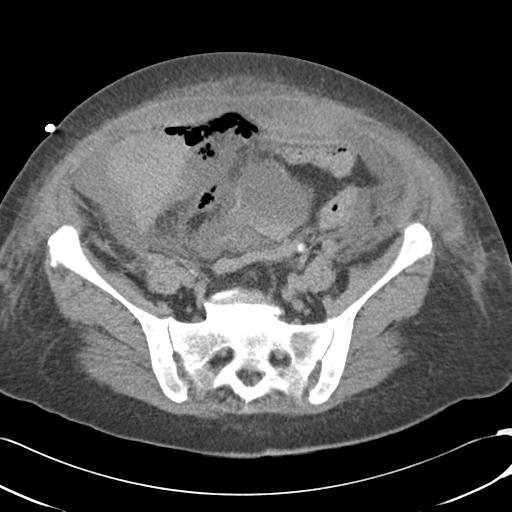 Bladder rupture post renal biopsy (Radiopaedia 30863-31572 Axial non-contrast 64).jpg