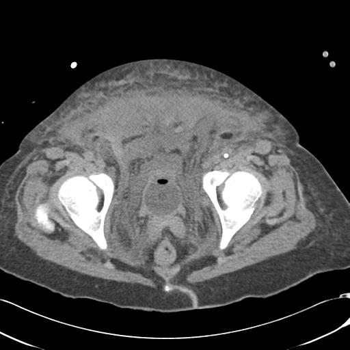 File:Bladder rupture post renal biopsy (Radiopaedia 30863-31572 Axial non-contrast 81).jpg