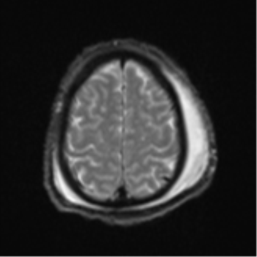 Blunt cerebrovascular injury (Radiopaedia 53682-59745 Axial DWI 25).png