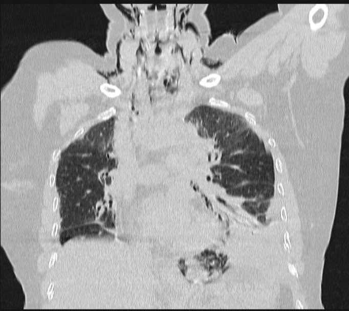 Boerhaave syndrome (Radiopaedia 45644-49799 Coronal lung window 31).jpg