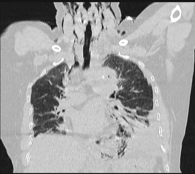 Boerhaave syndrome (Radiopaedia 45644-49799 Coronal lung window 34).jpg