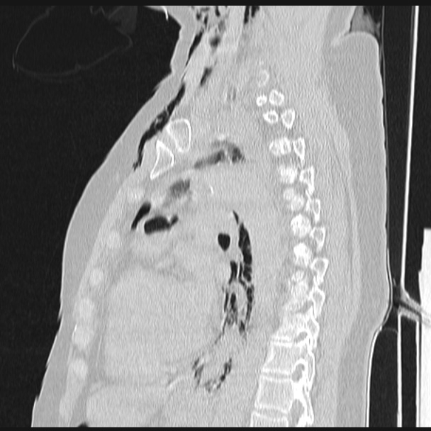 Boerhaave syndrome (Radiopaedia 45644-49799 Sagittal lung window 49).jpg