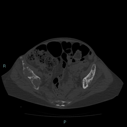 File:Bone metastases from untreated breast cancer (Radiopaedia 42973-46219 Axial bone window 164).jpg