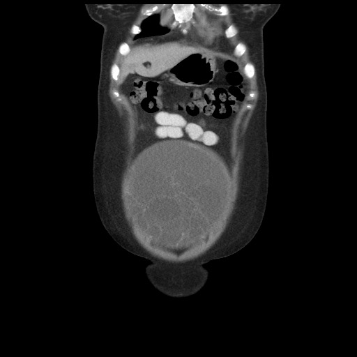 Borderline mucinous tumor (ovary) (Radiopaedia 78228-90808 C 11).jpg