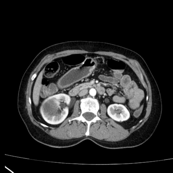 Bosniak renal cyst - type I (Radiopaedia 27479-27675 renal cortical phase 35).jpg