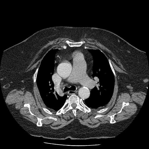 Bovine aortic arch - right internal mammary vein drains into the superior vena cava (Radiopaedia 63296-71875 A 53).jpg