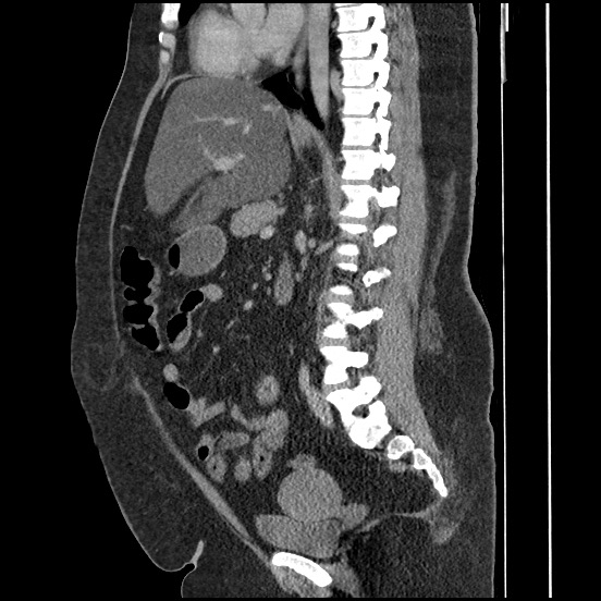 File:Bowel and splenic infarcts in acute lymphocytic leukemia (Radiopaedia 61055-68913 C 39).jpg
