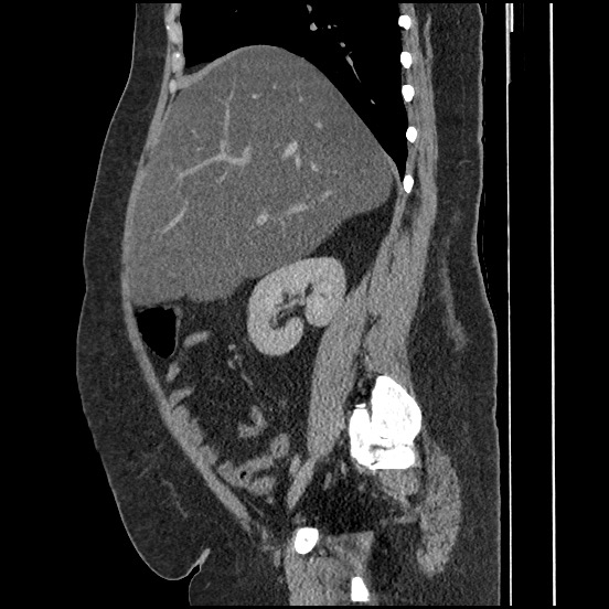 Bowel and splenic infarcts in acute lymphocytic leukemia (Radiopaedia 61055-68913 C 51).jpg