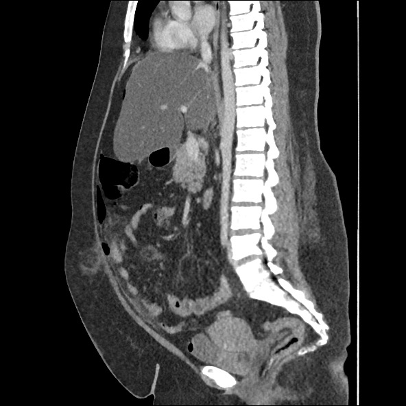 Bowel and splenic infarcts in acute lymphocytic leukemia (Radiopaedia 61055-68915 C 36).jpg