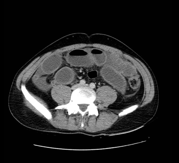 Bowel obstruction from colon carcinoma (Radiopaedia 22995-23028 A 55).jpg