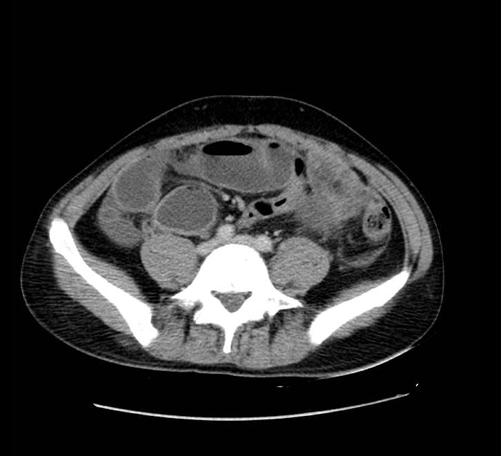 Bowel obstruction from colon carcinoma (Radiopaedia 22995-23028 A 57).jpg