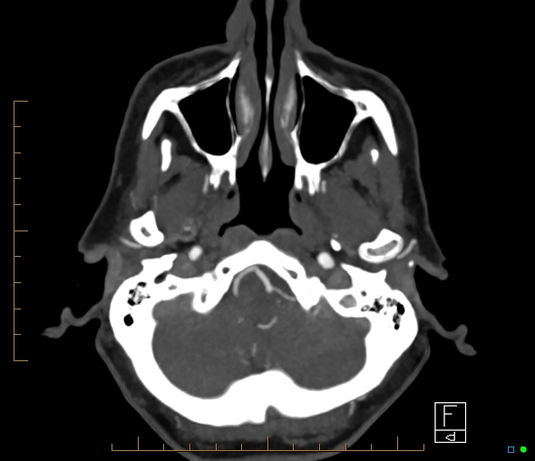 File:Brachiocephalic trunk stenosis (Radiopaedia 87242-103519 A 60).jpg